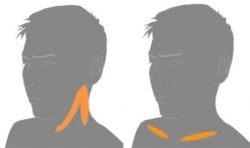 首の痛み