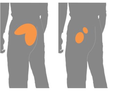 腰からお尻の痛み