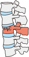 圧迫骨折 いつの間にか骨折