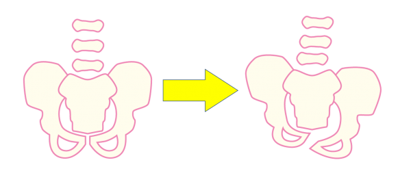 骨盤のゆがみ