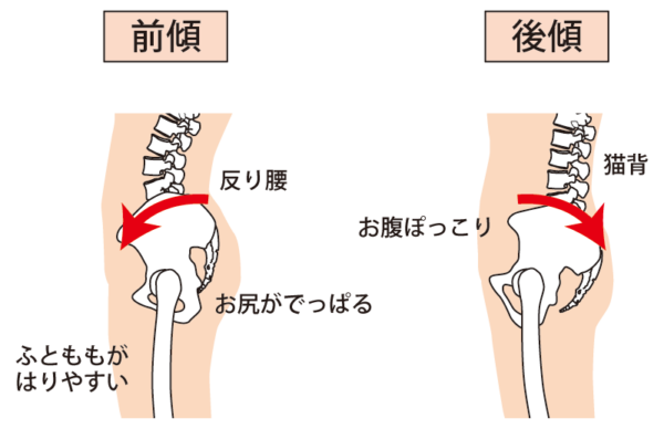 反り腰