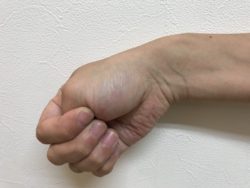 ドケルバン病の確認